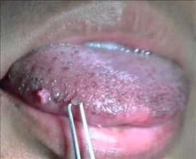 virus do papiloma humano na lingua