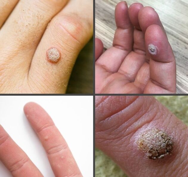 Tipos comúns de verrugas nos dedos